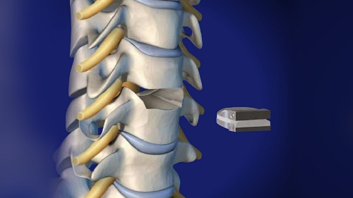 cervical disk replacement