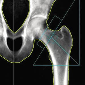 Bone Density Scan (DEXA Scan) in CO