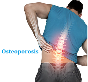 osteoporosis blog image